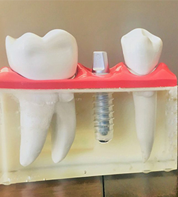 Dental-implants-small size